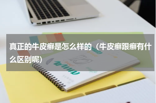 真正的牛皮癣是怎么样的（牛皮癣跟癣有什么区别呢）